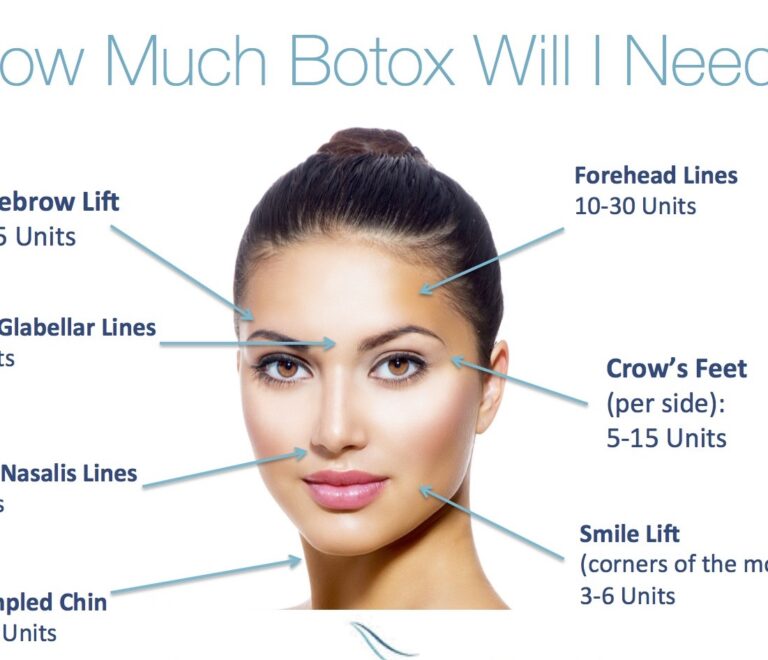 How many units of Botox do you need?