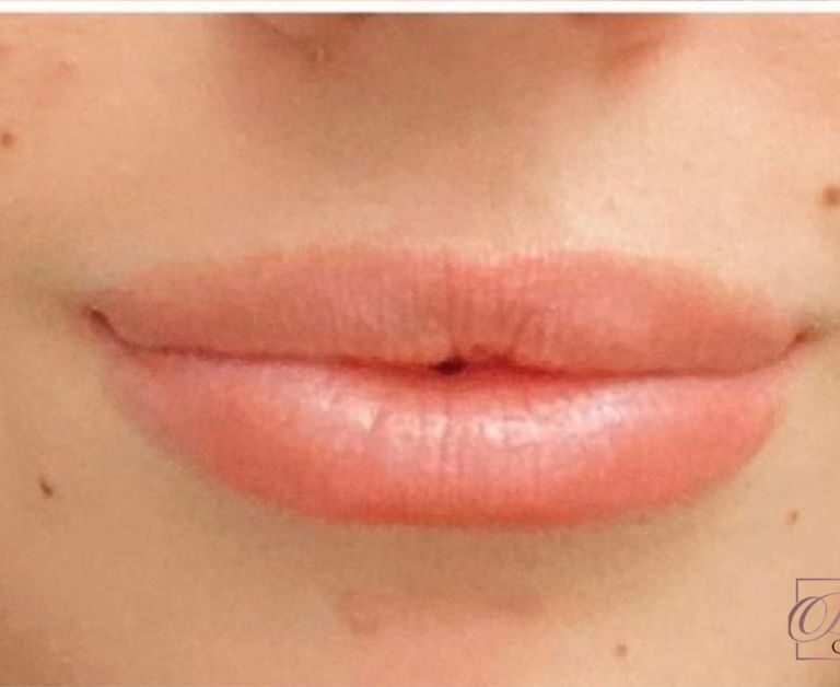 Where to Inject Botox for Lip Flip?