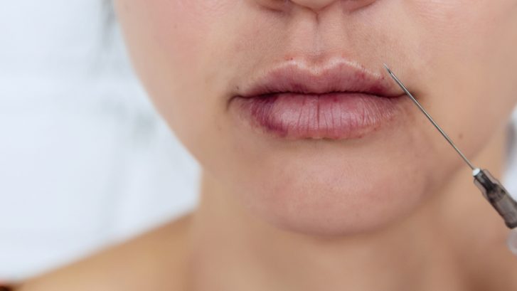 How Long Do Lip Fillers Last?