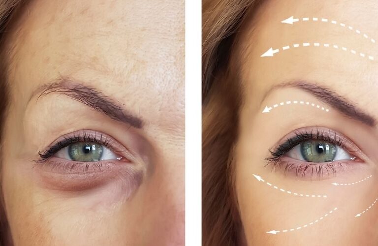 The Duration of Botox: How to make Botox last longer
