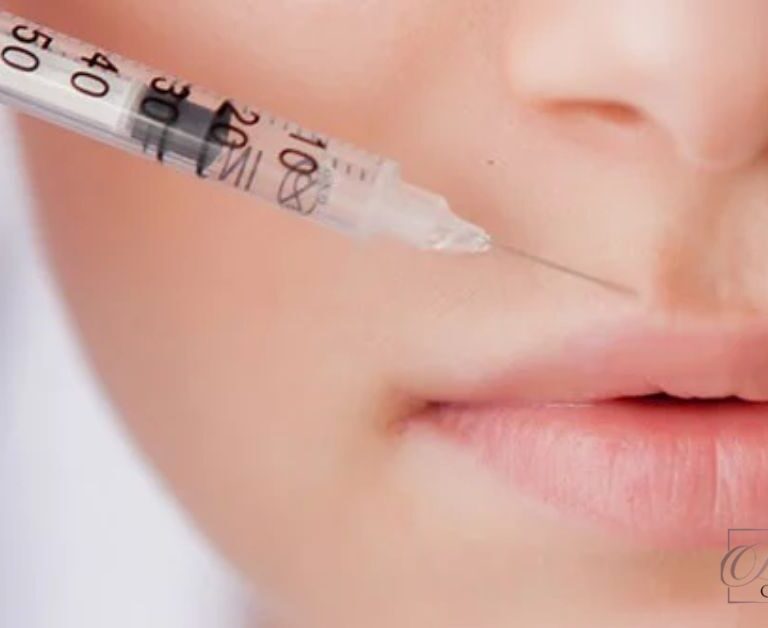 How Long Does Botox Lip Flip Last?
