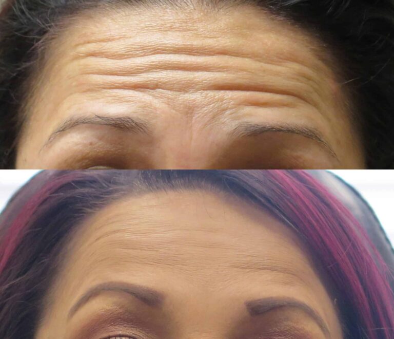 How to get rid of forehead wrinkles without Botox?