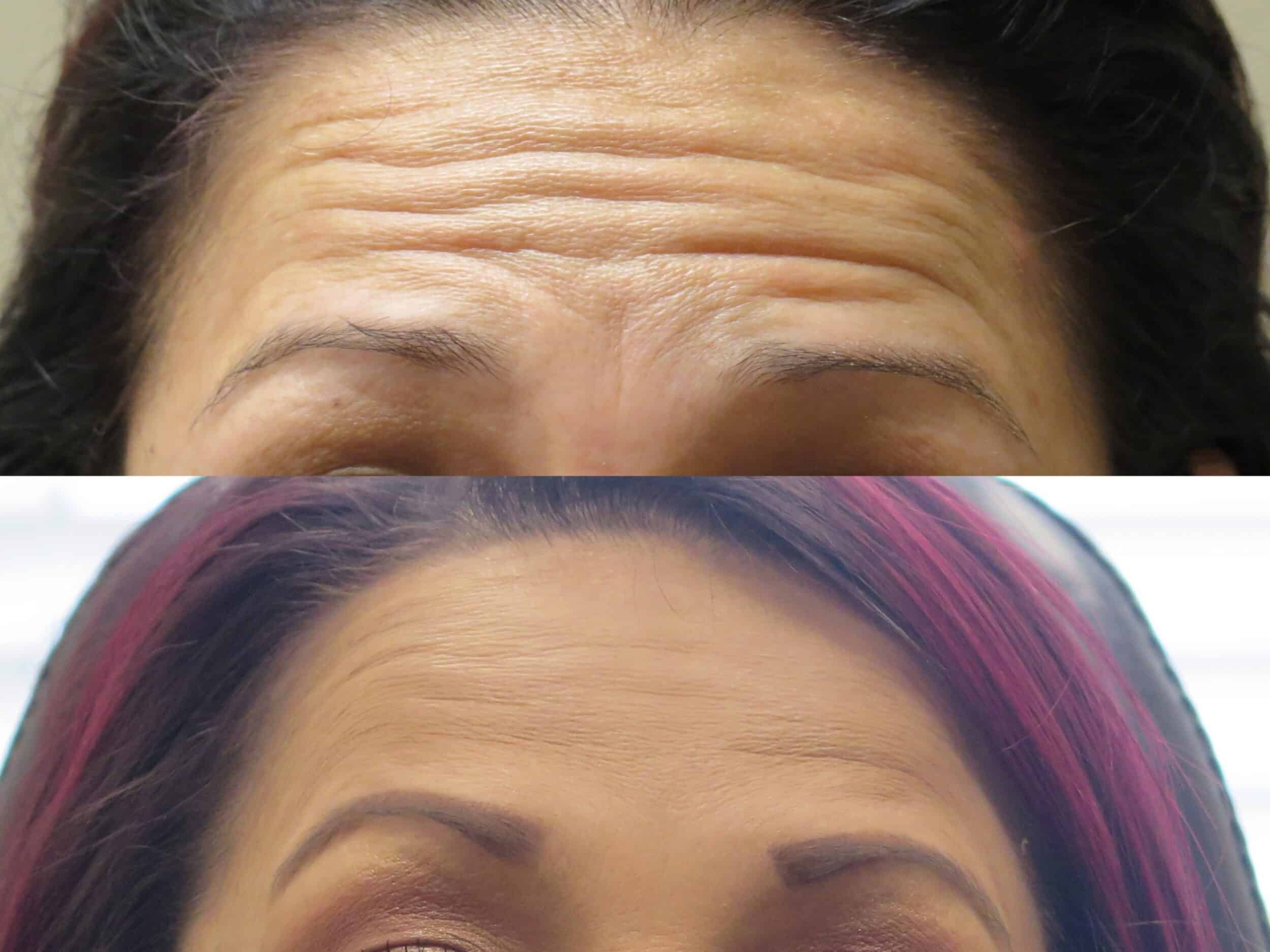 How to get rid of forehead wrinkles without Botox