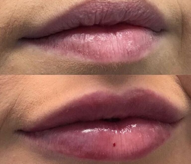 Enhance Your Smile: Dramatic Lip Filler Before And After