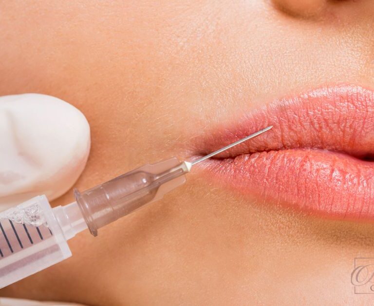 How Long Do Lip Fillers Last Juvederm?