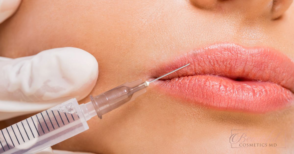 How Long Do Lip Fillers Last Juvederm